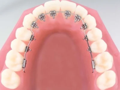 Produtos ortodônticos dentais dos suportes linguais do metal mini cintas dos dentes de Roth